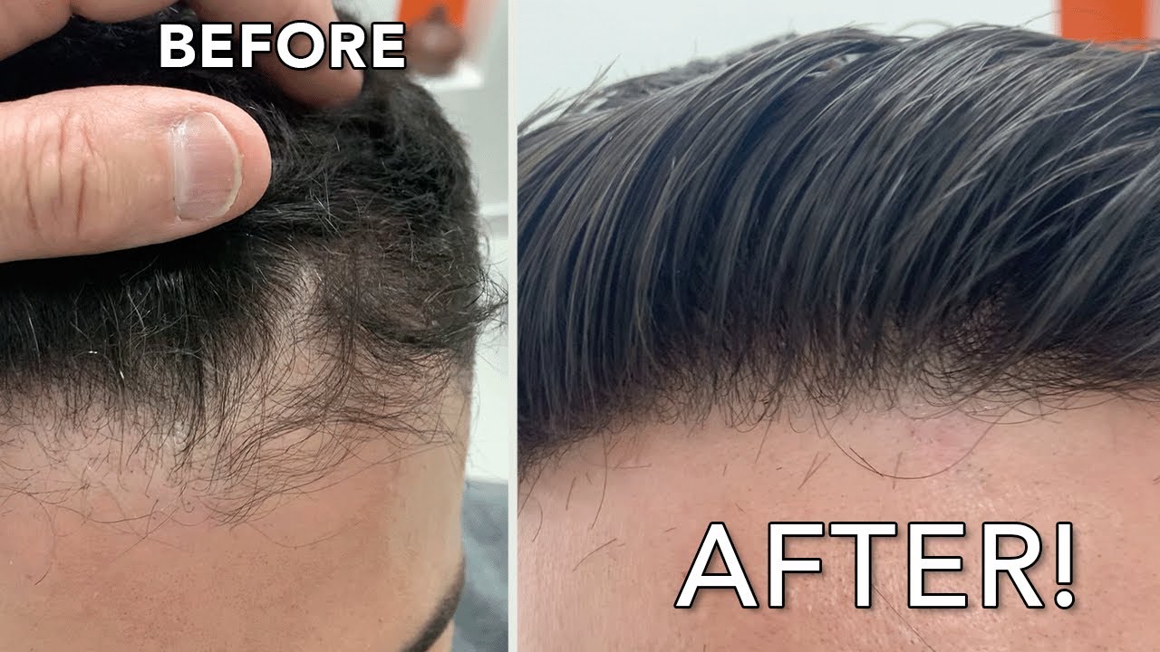 Chuck Alfieri Italian Hair Replacement for Men - 13 Different Attachments Available