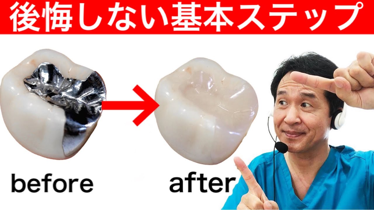 銀歯を外して、白い歯セラミックへ変える際の注意点
