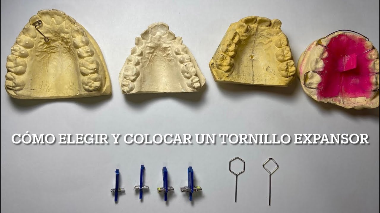 Cómo elegir y colocar un Tornillo Expansor