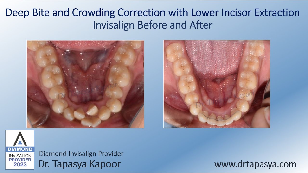 Deep Bite and Crowding Correction with Lower Incisor Extraction - Invisalign Before and After