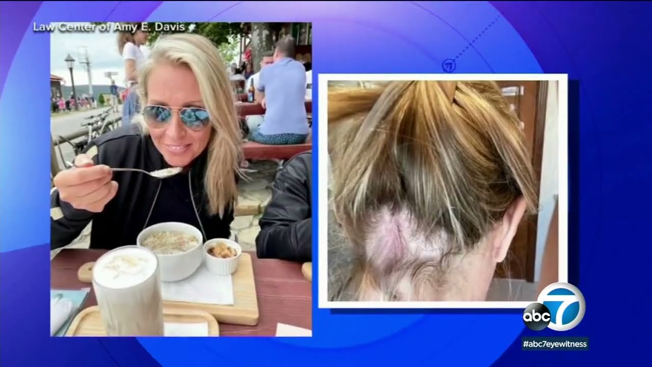 Olaplex hair products left customers with bald spots, blisters, lawsuit alleges