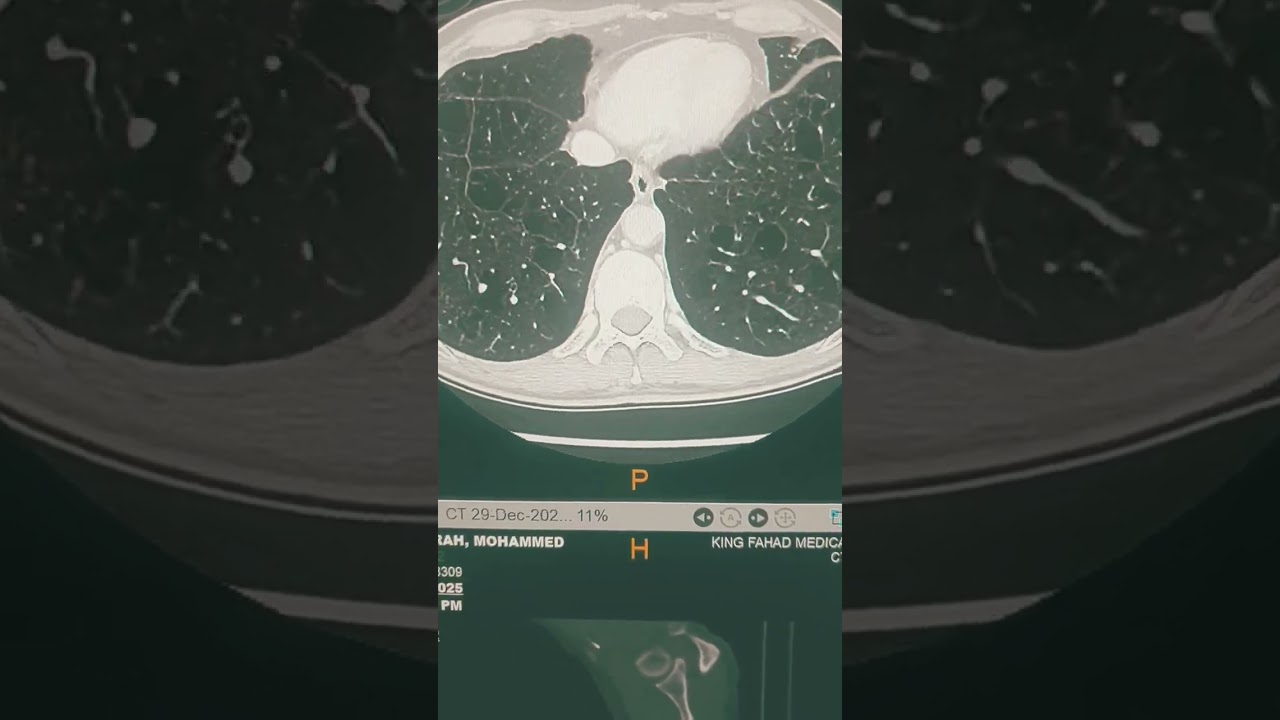 Cystic lung disease: lung metastasis from UB ca transformed  to pure cysts after successful treated