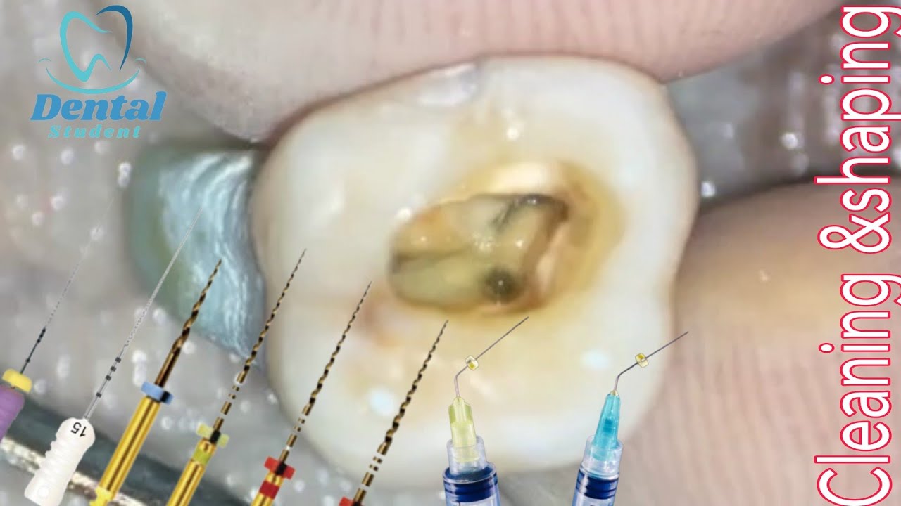 Root canal Cleaning and Shaping Using Rotary Files