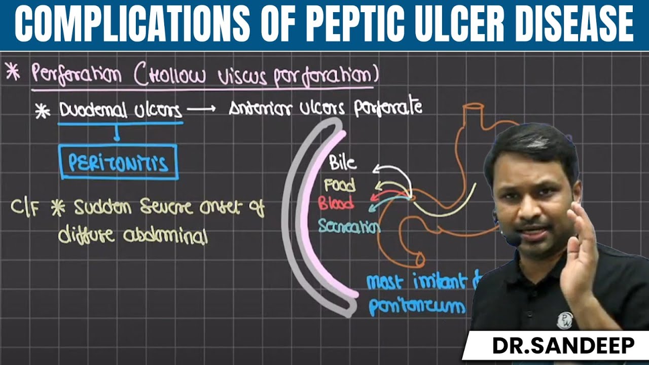 Complications of Peptic Ulcer Disease | Surgery | Bailey learned with Dr. Sandeep | PW MedEd
