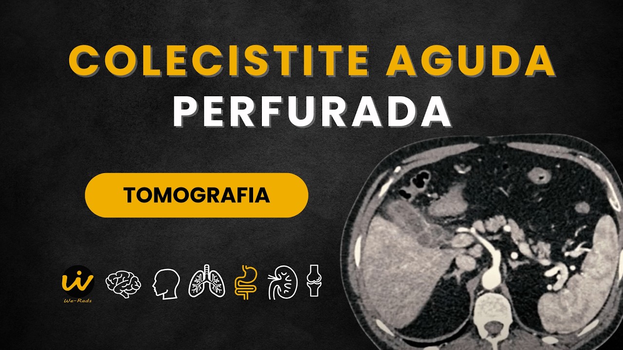 COLECISTITE AGUDA PERFURADA na TOMOGRAFIA
