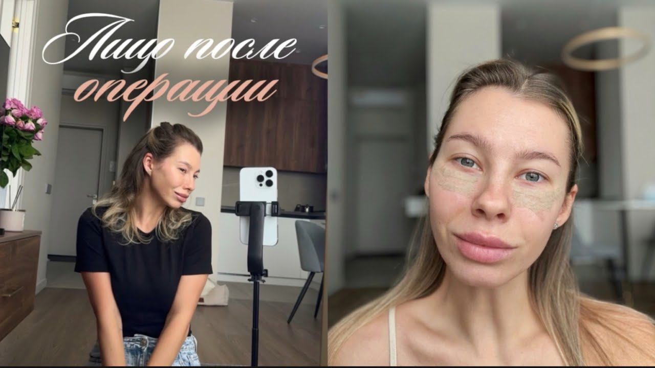 Сняла пластыри после блефаропластики. Впервые показываю себя без отёков. Лицо ДО и ПОСЛЕ операции