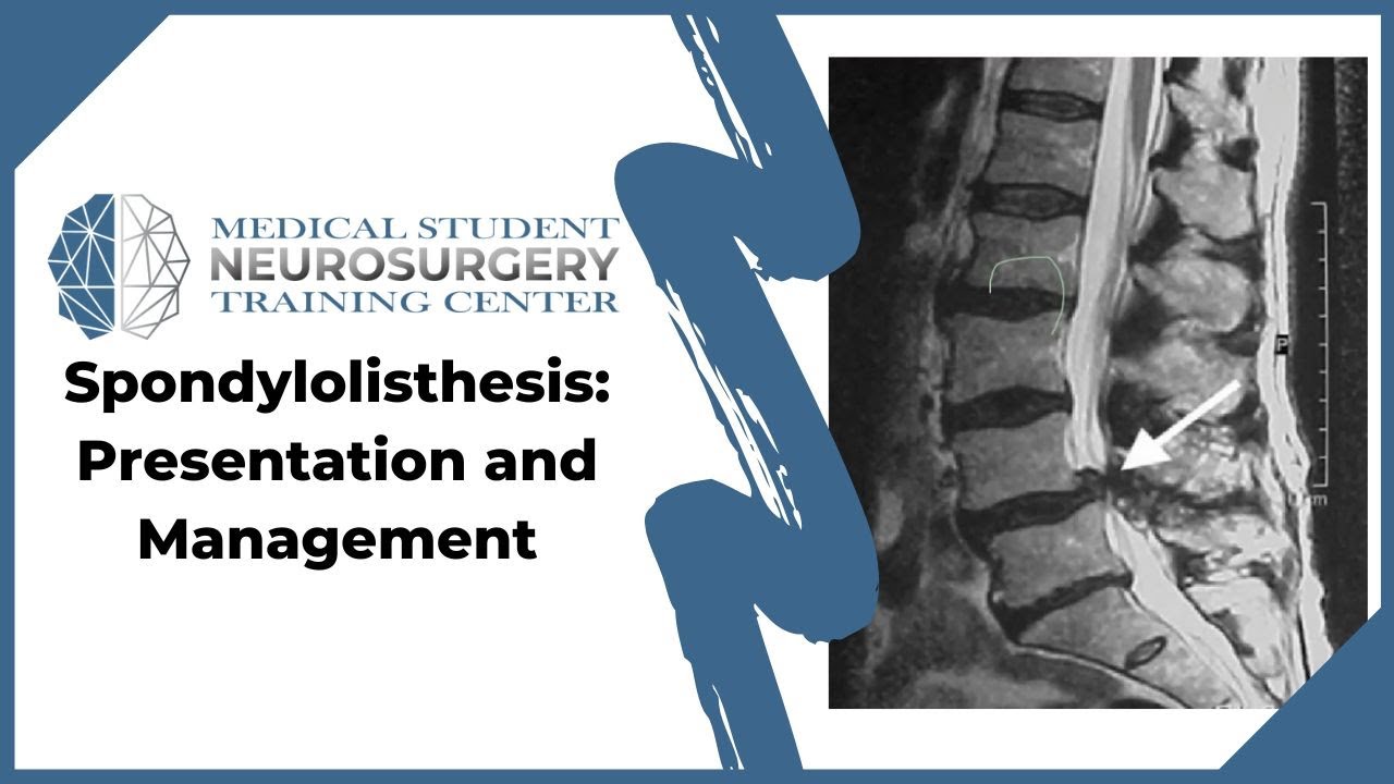 Spondylolisthesis: Presentation and Management