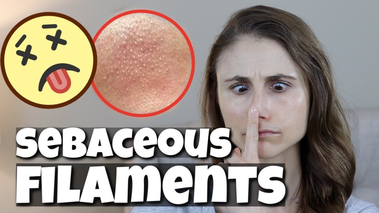 GET RID OF SEBACEOUS FILAMENTS| DR DRAY