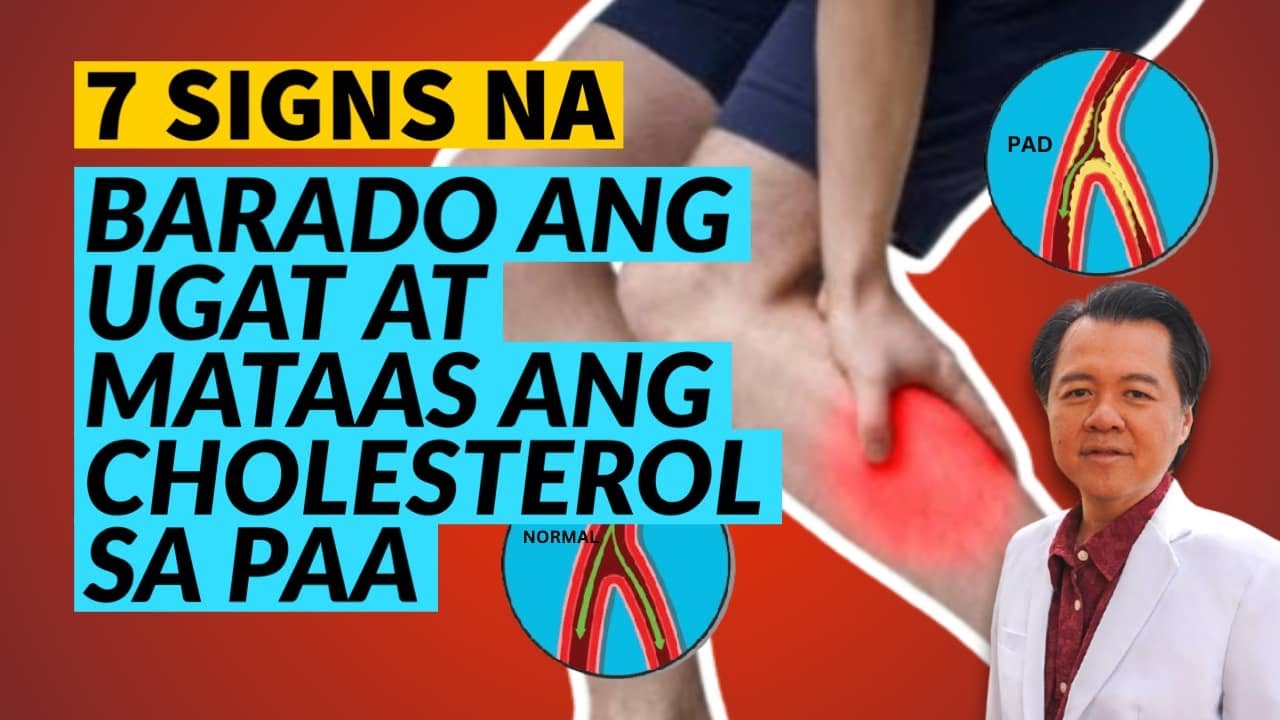7 Senyales na Mataas ang Cholesterol sa Paa at Barado Ang Ugat