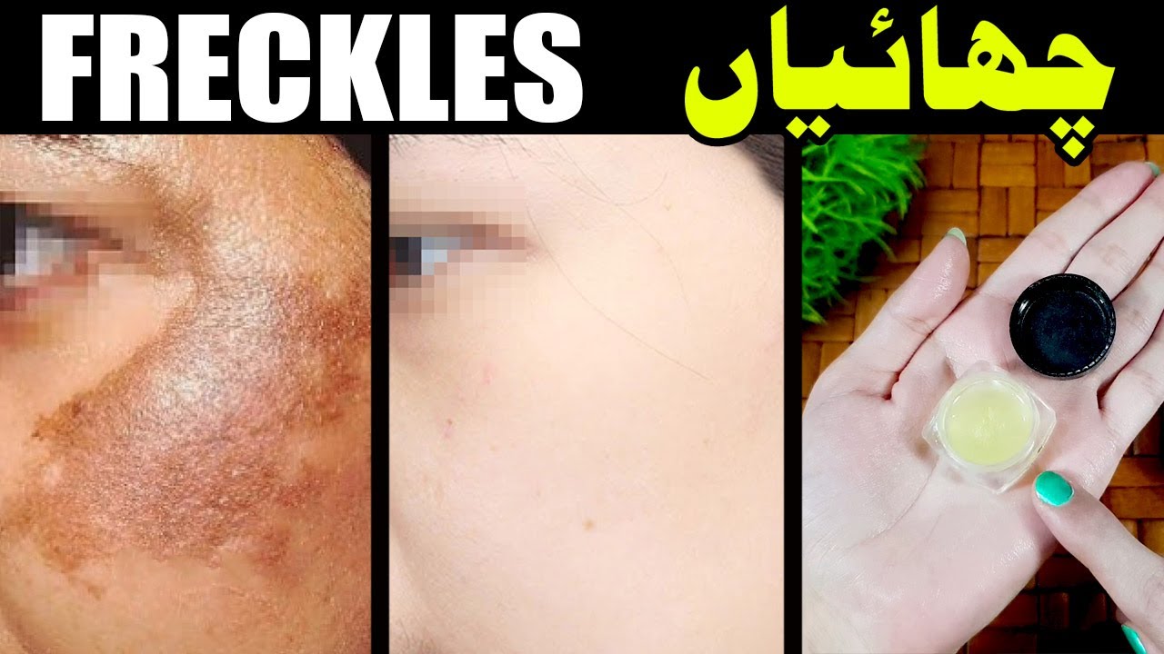 Apply Just 1 Drop on FRECKLES, MELASMA, PIGMENTATION at Night & See Magic Urdu Hindi