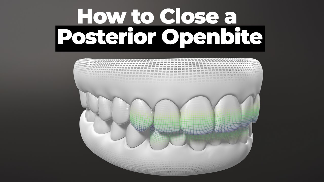 How to Close a Posterior Openbite  www.GPwebinar.com