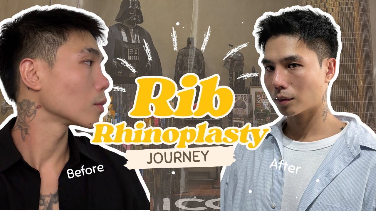 RIB RHINOPLASTY Journey at The Icon Clinic with Doc Yappy | JEFF ONG