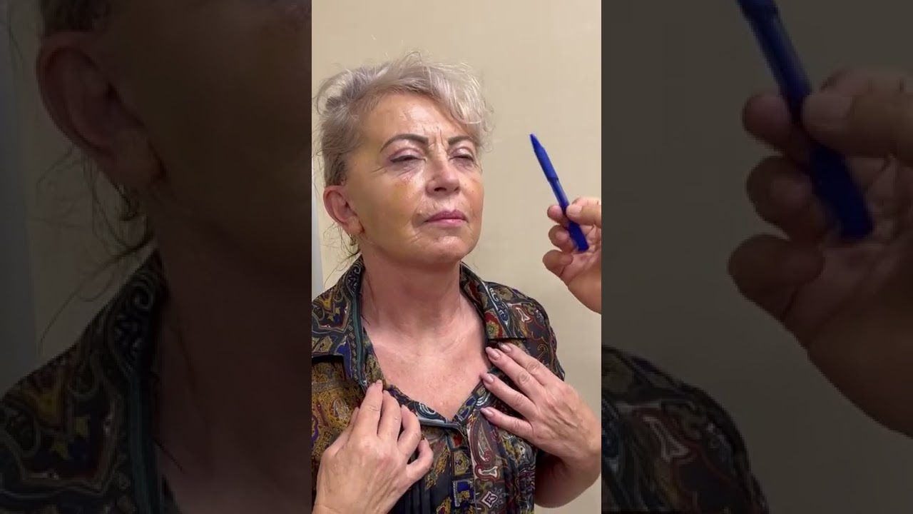 Control postoperator la 14 zile dupa un lifting cervico-facial