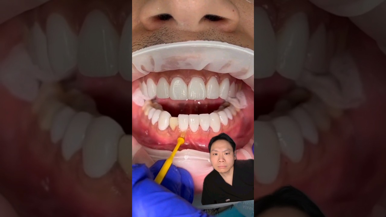 Dentist Reacts: Non-invasive Porcelain Veneers #porcelainveneers #smile #smilemakeover