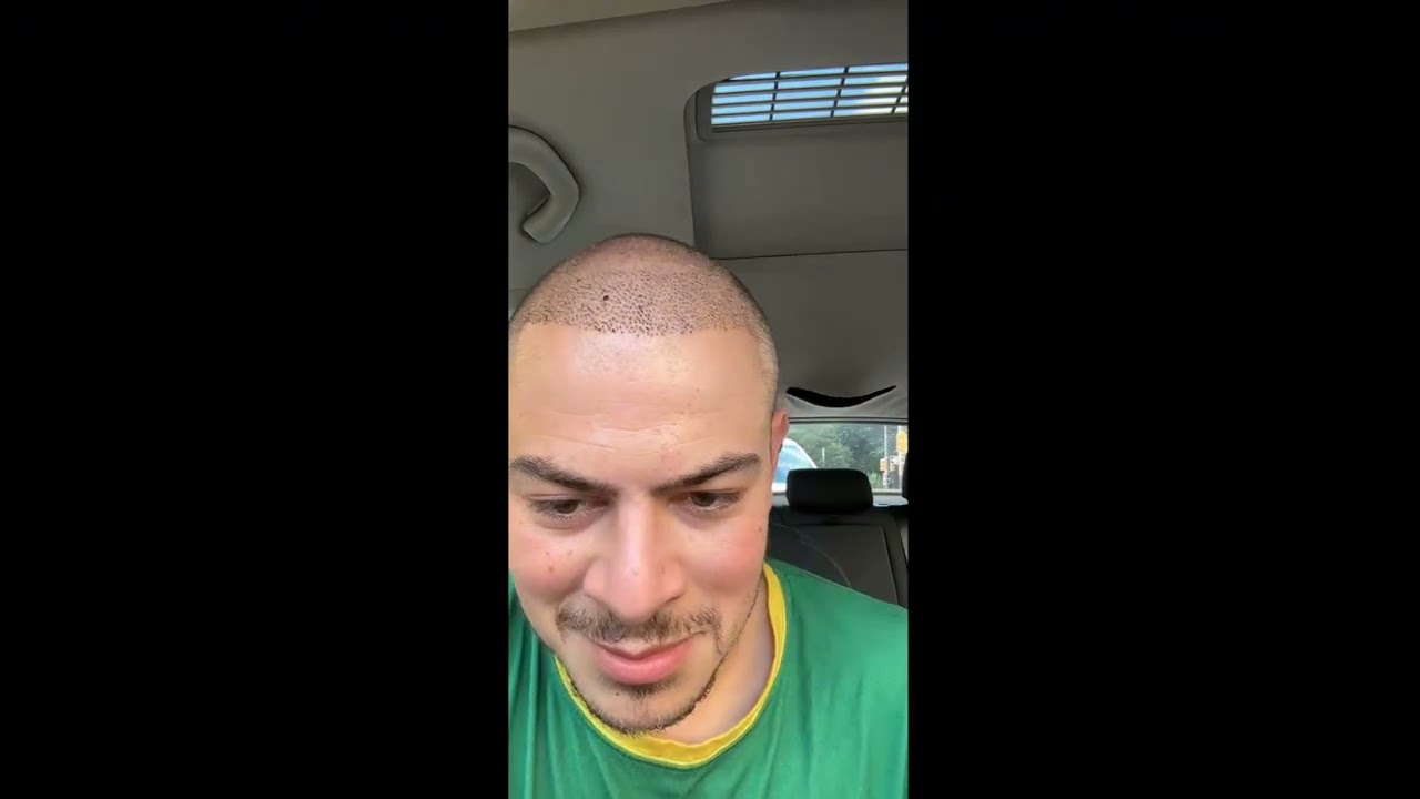 سيد أحمد يحكي على عملية لدارها لزرع الشعر و يحكي على الربور زادكا قريب رجعني لطريق
