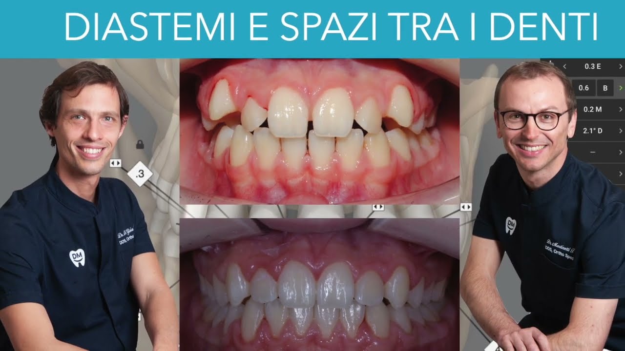 Chiusura diastemi o spazi tra i denti - prima e dopo con allineatori trasparenti