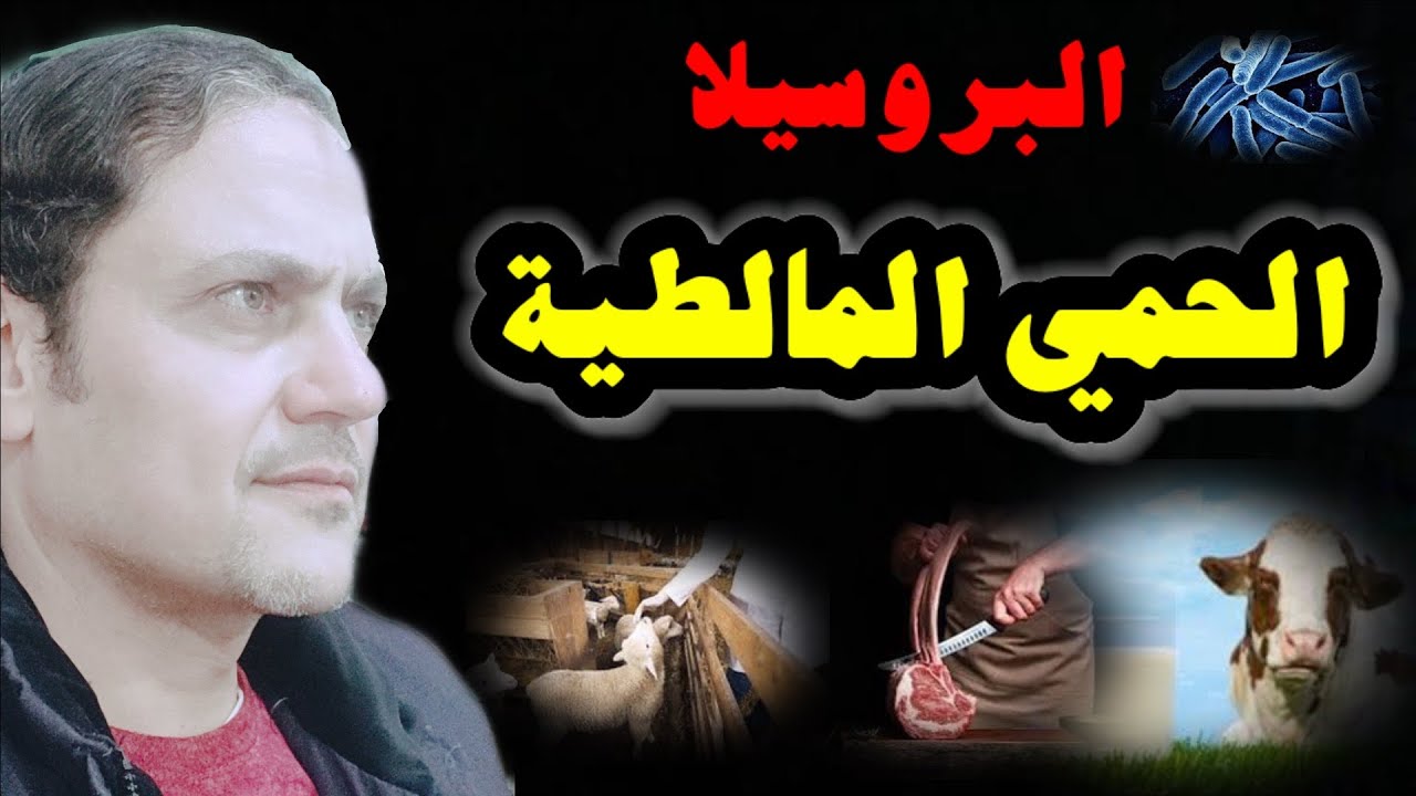 حمي المالطية | بروسيلا | Malta fever |  الاسباب | والاعراض | والمضاعفات |والعلاج #البروسيلا