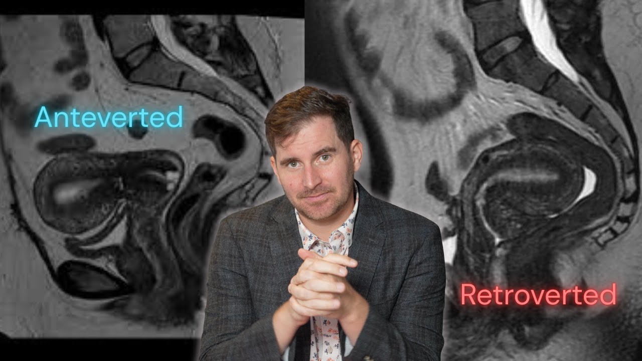 Tilted Uterus? Why did the doctor say this? Is it a problem?