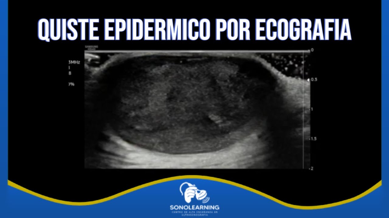 QUISTE EPIDERMICO POR ECOGRAFIA