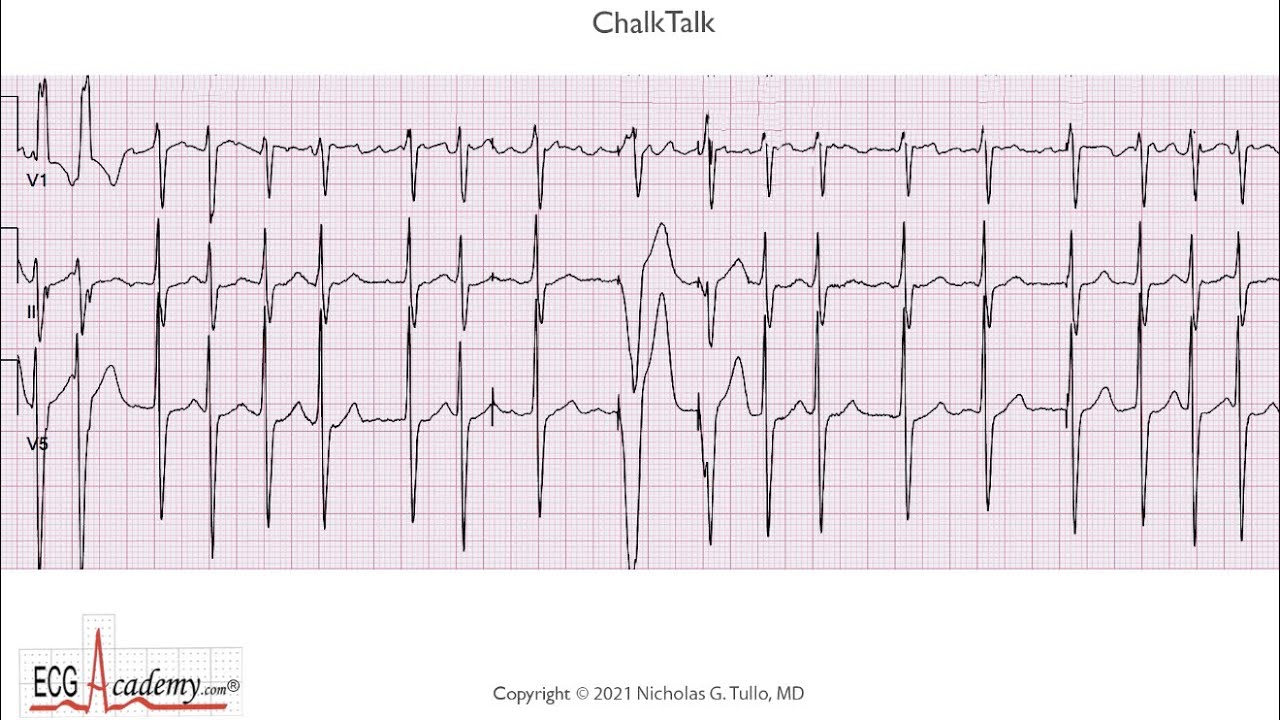 ECG Lesson in Advanced Pacemaker Troubleshooting