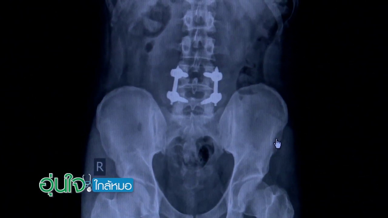 กระดูกสันหลังร้าว จากอุบัติเหตุหกล้ม
