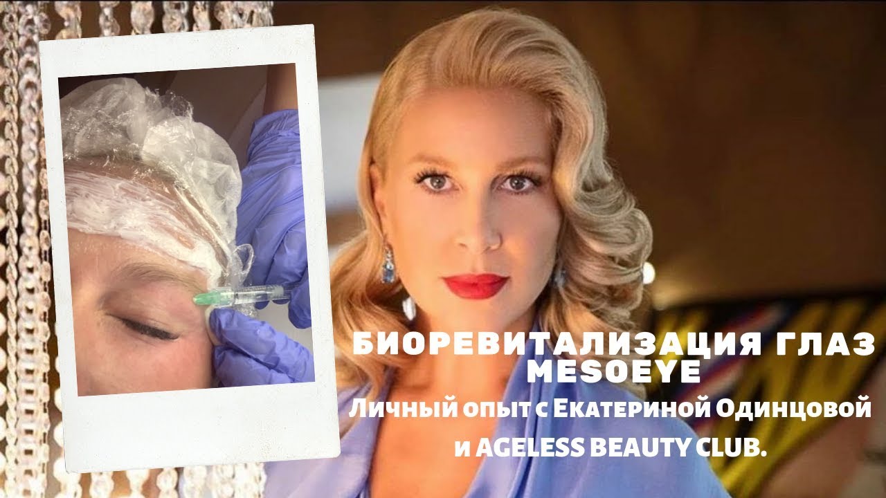 Личный опыт биоревитализация глаз, Mesoeye уколы зоны вокруг глаз, Видео до и после через неделю