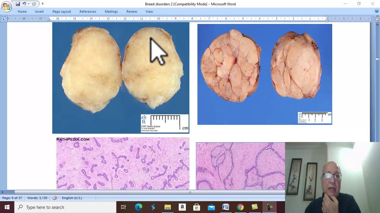 Breast Disorders in Arabic 16 ( Fibroadenoma) , by Dr. Wahdan .