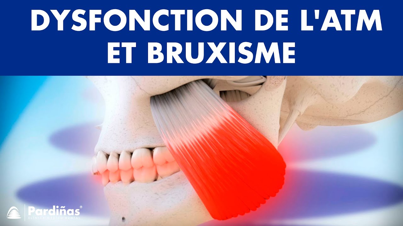 Dysfonction de l'articulation temporo mandibulaire et bruxisme ©