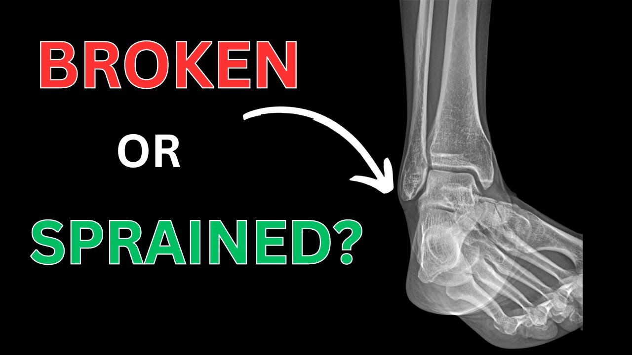 Are you walking on a broken ankle? When to get xrays after a sprain!