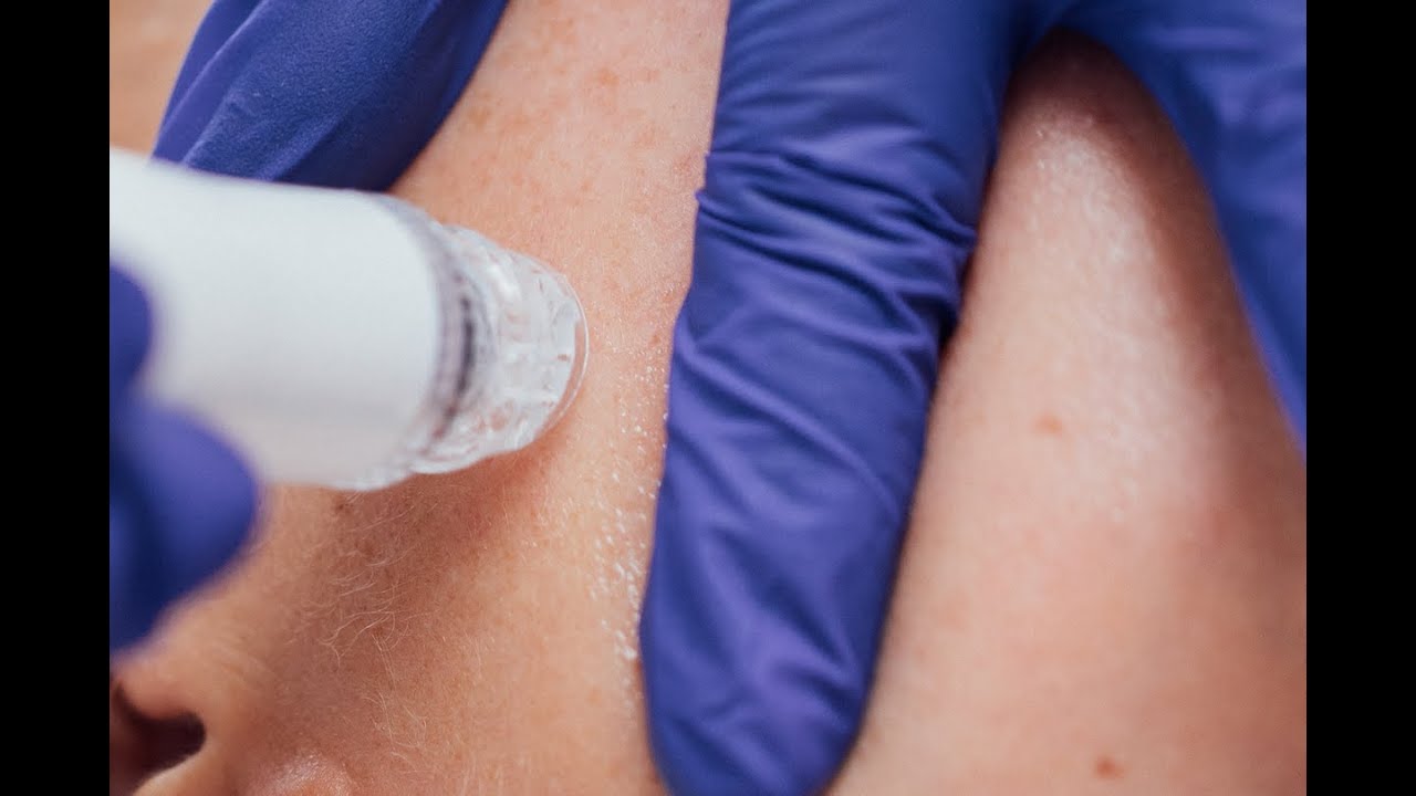 ONA Hydrodermabrasie
