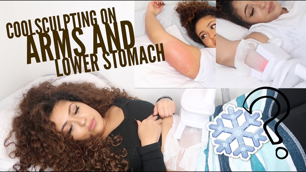 I had my fat frozen off! My Coolscuplting experience || Allthatbeautyjazz