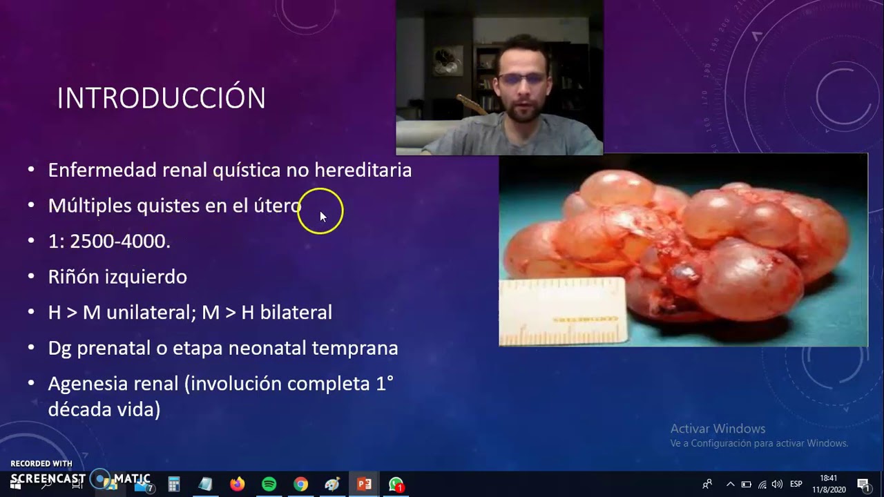 Displasia renal multiquistica