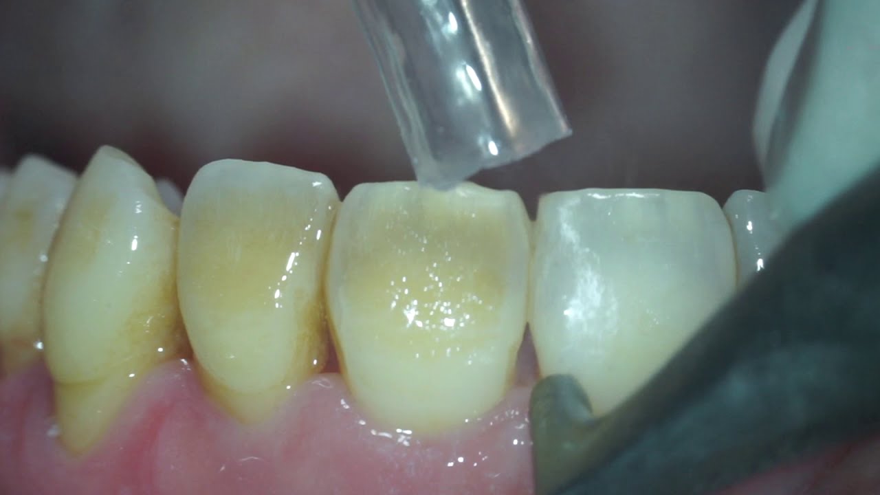 Biofilm, stains and young calculus removal from teeth