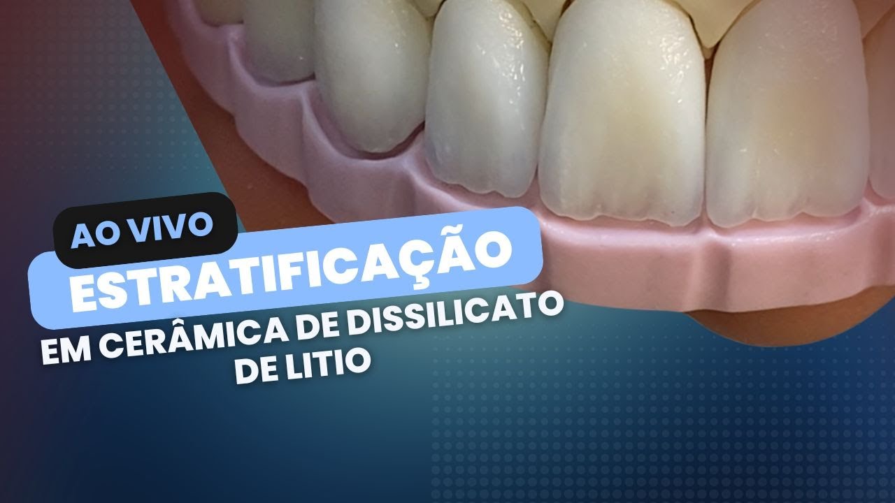 Facetas de ceramica de dissilicato de litio