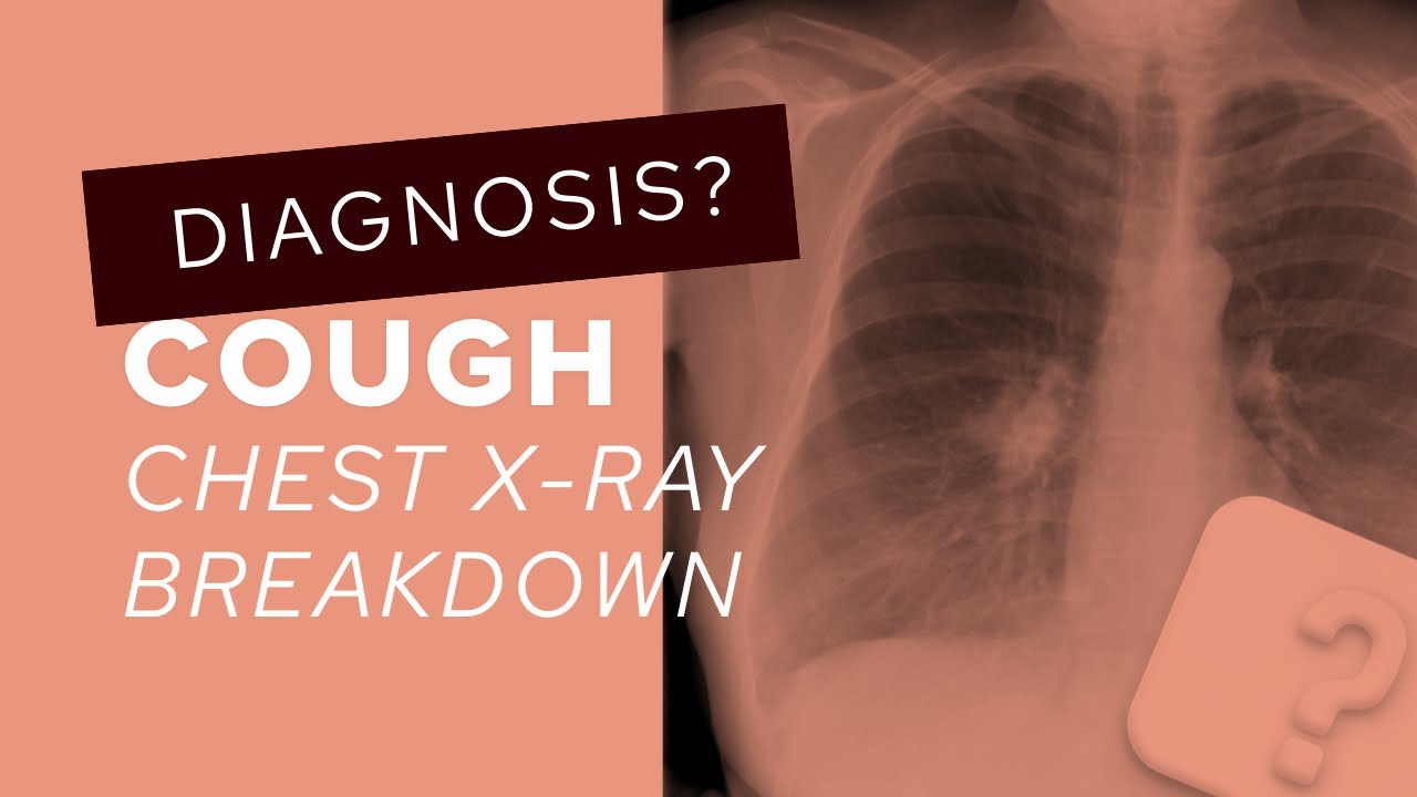 Chest X-Ray guide: how to assess the hilar regions