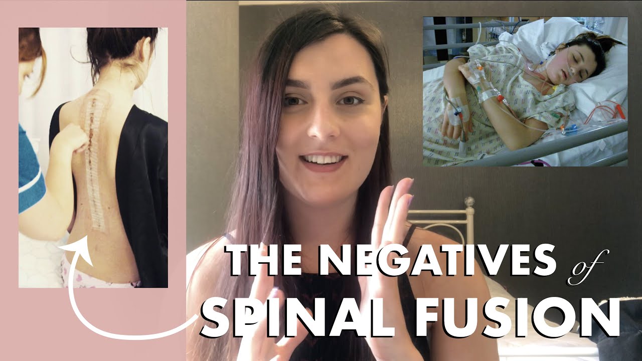 NEGATIVES OF SPINAL FUSION | Scoliosis Surgery