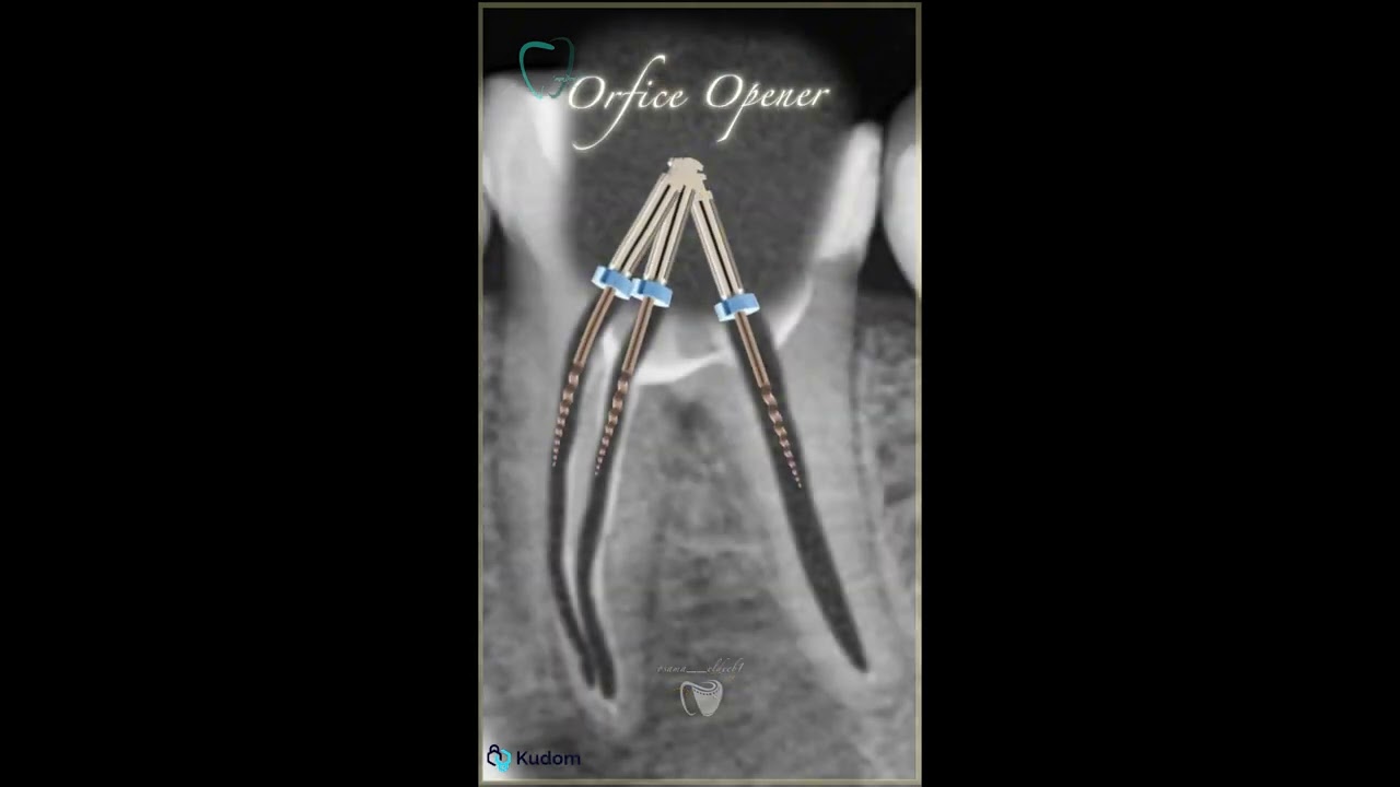 Triple MTA Apical Plug