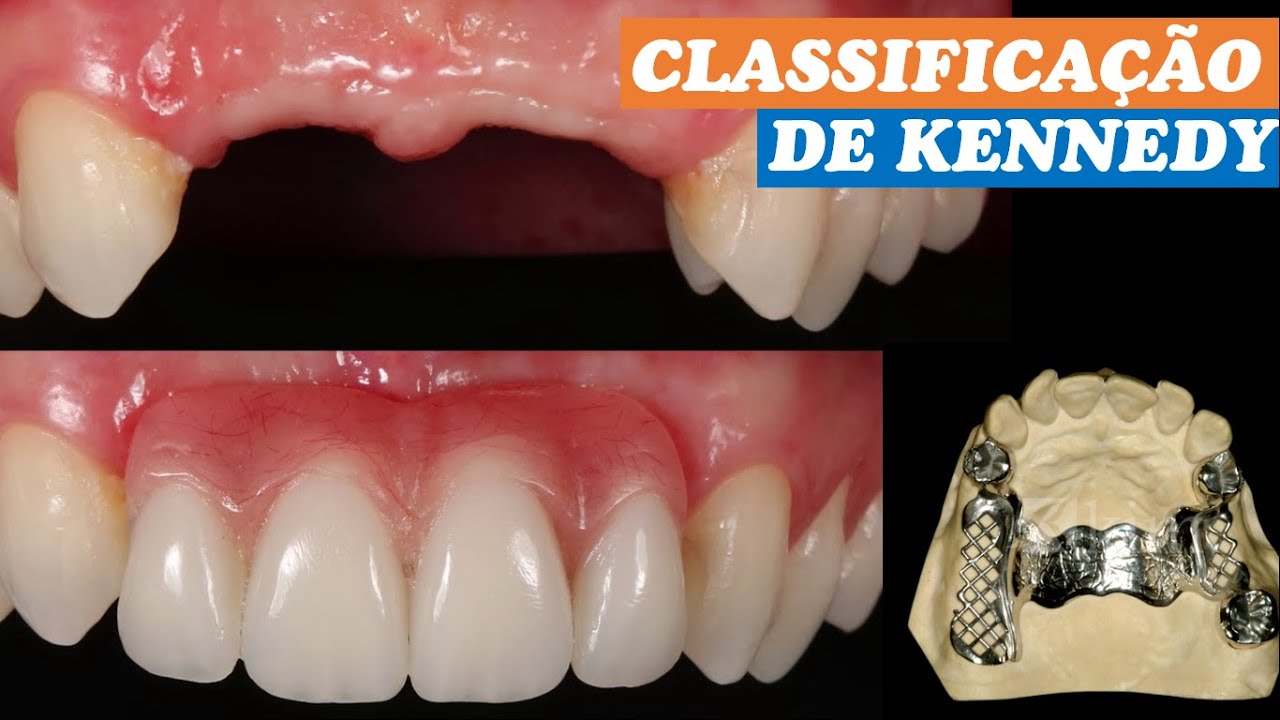 Classificação De Kennedy e Applegate