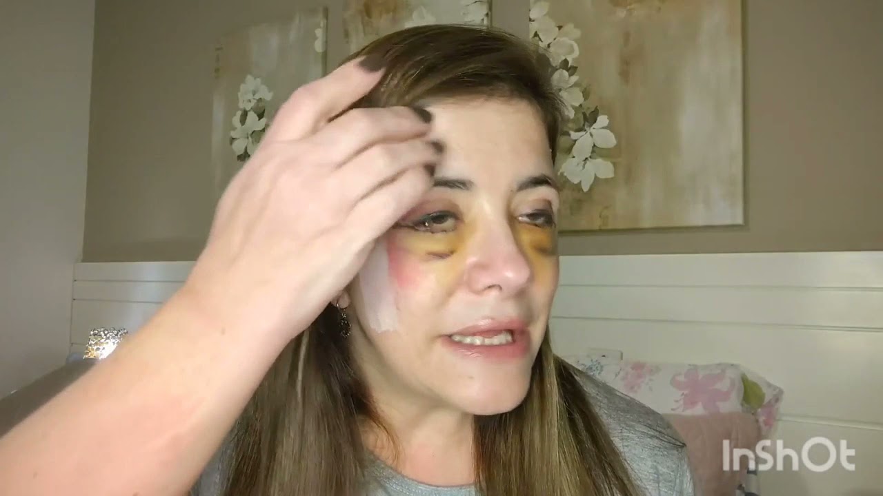 Minha Blefaroplastia deu errado Parte 1