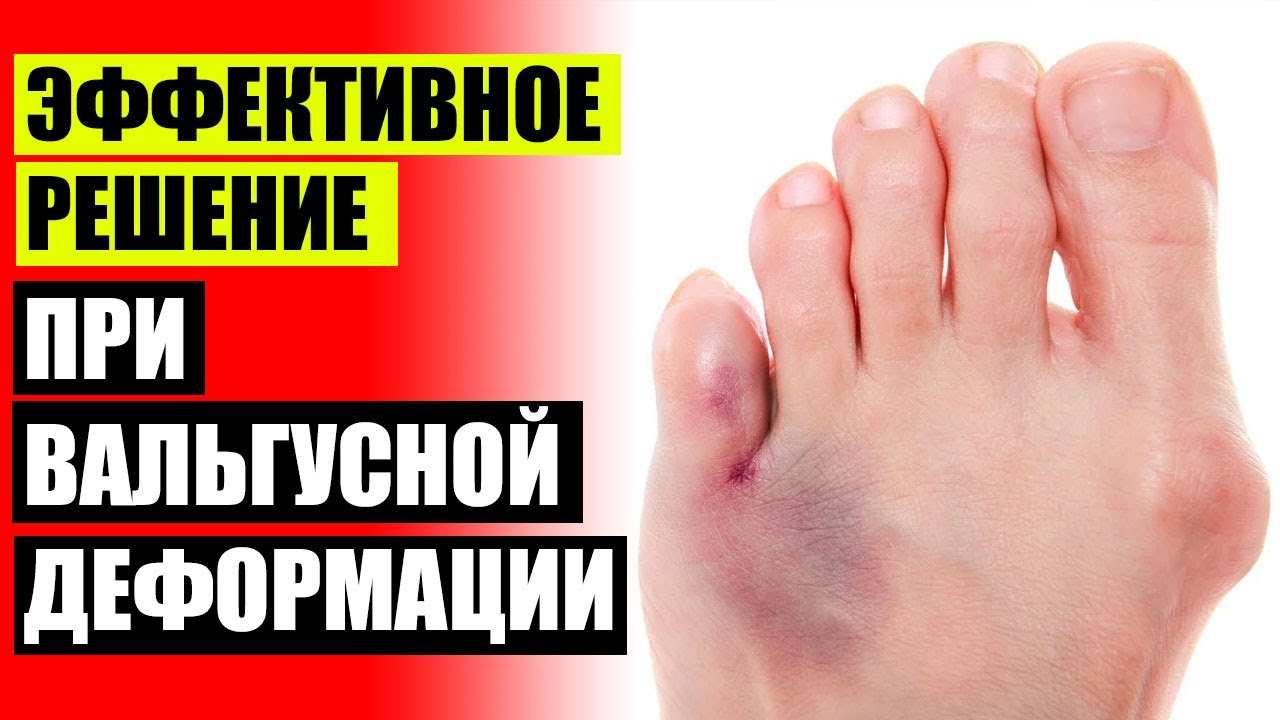 Болит кость на ноге у большого пальца 🤘 Шарнирная шина hallufix