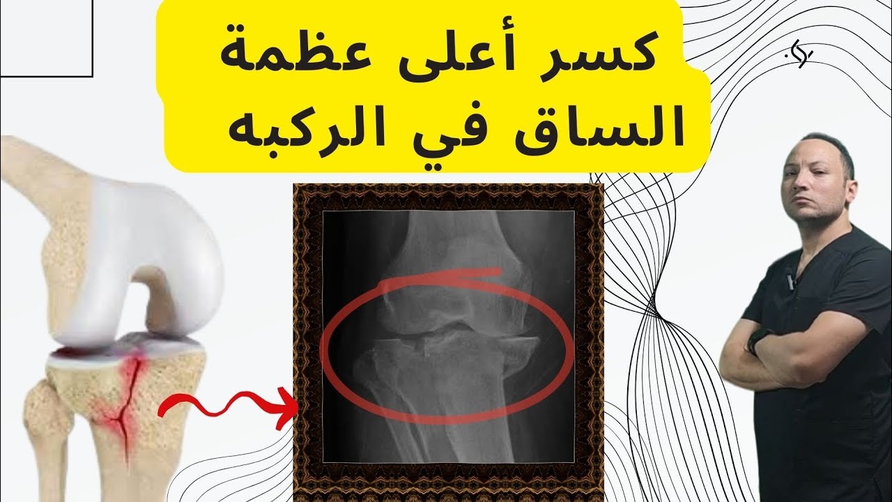 كسر أعلى عظمة الساق في مفصل الركبه tibial plateau fracture