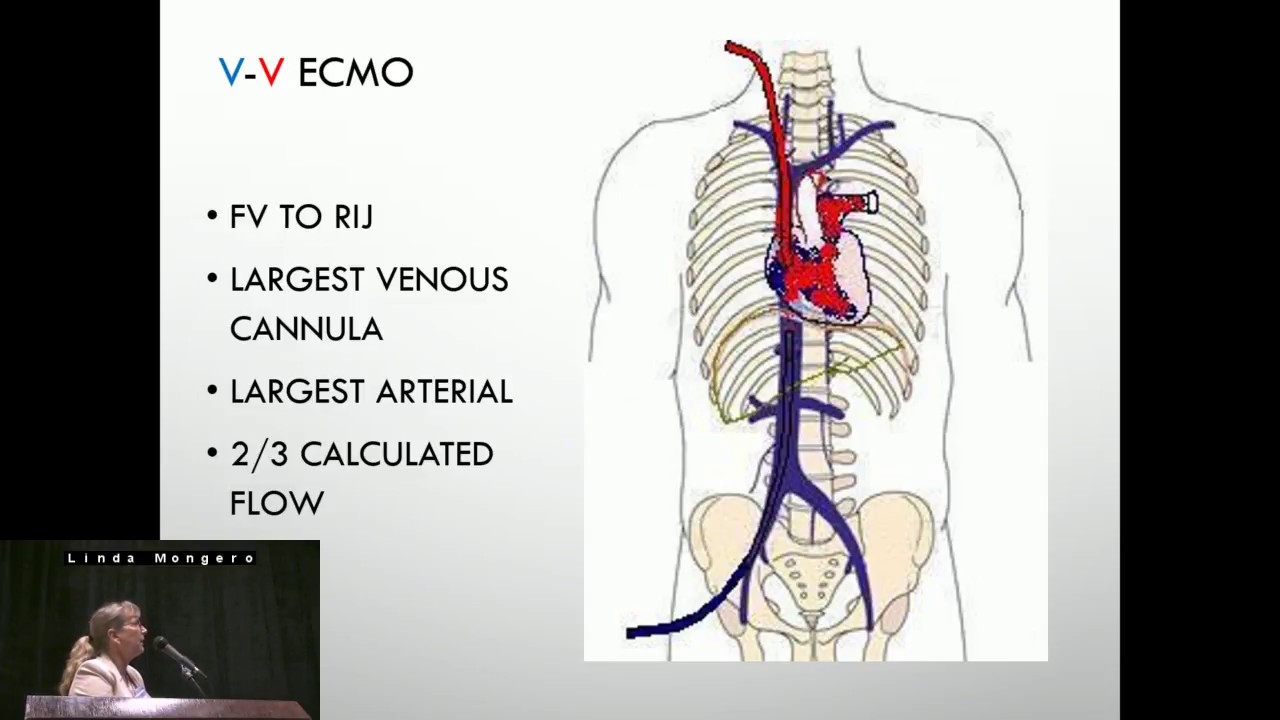 ECMO Cannulation Methods Per Diagnosis