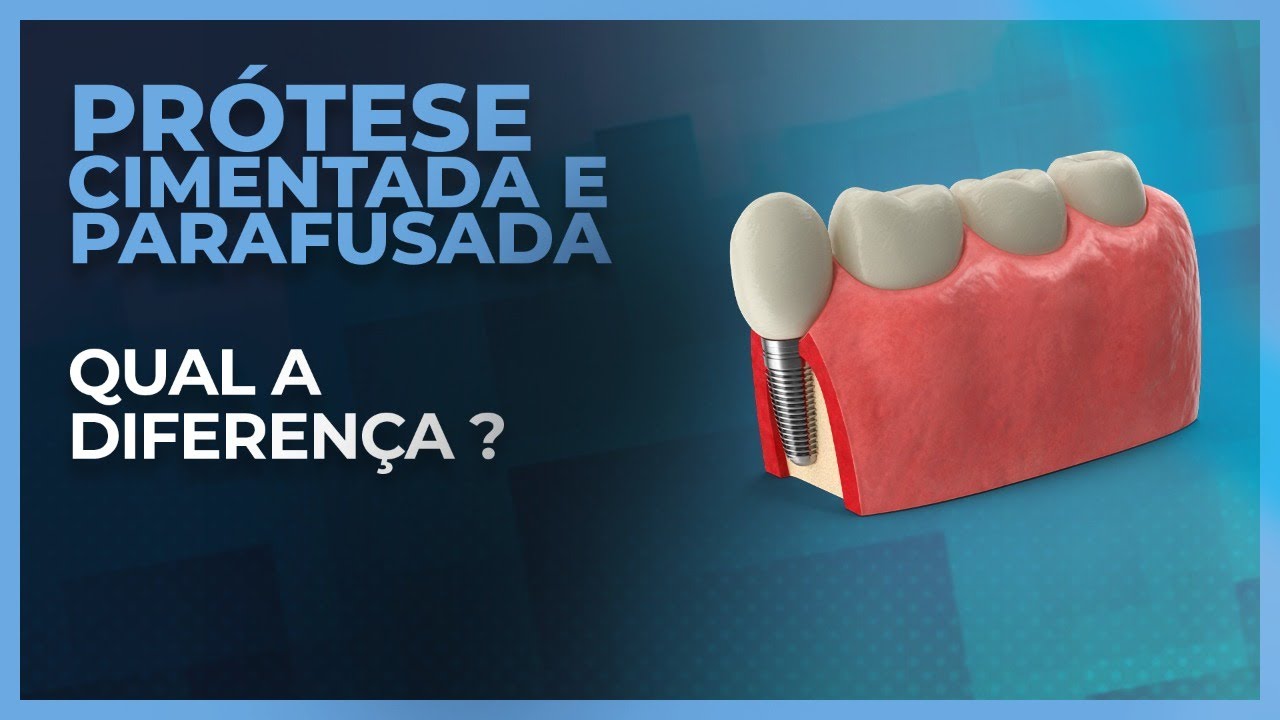 PRÓTESE SOBRE IMPLANTES CIMENTADA E PRÓTESE PARAFUSADA - DIFERENÇAS