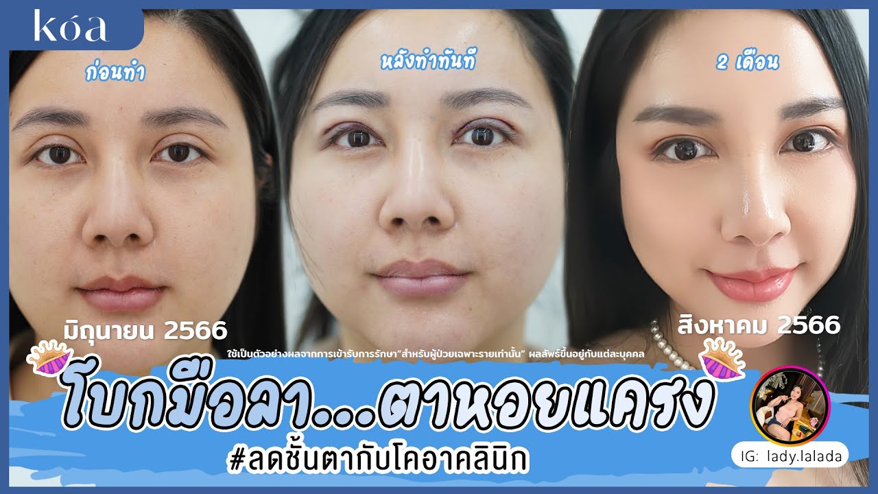 รีวิวเคสคุณลดา แก้ตาสองชั้นหนา + กล้ามเนื้อตาอ่อนแรง | ชั้นตาธรรมชาติ สวยเกาหลี โดยหมอกร KOA clinic