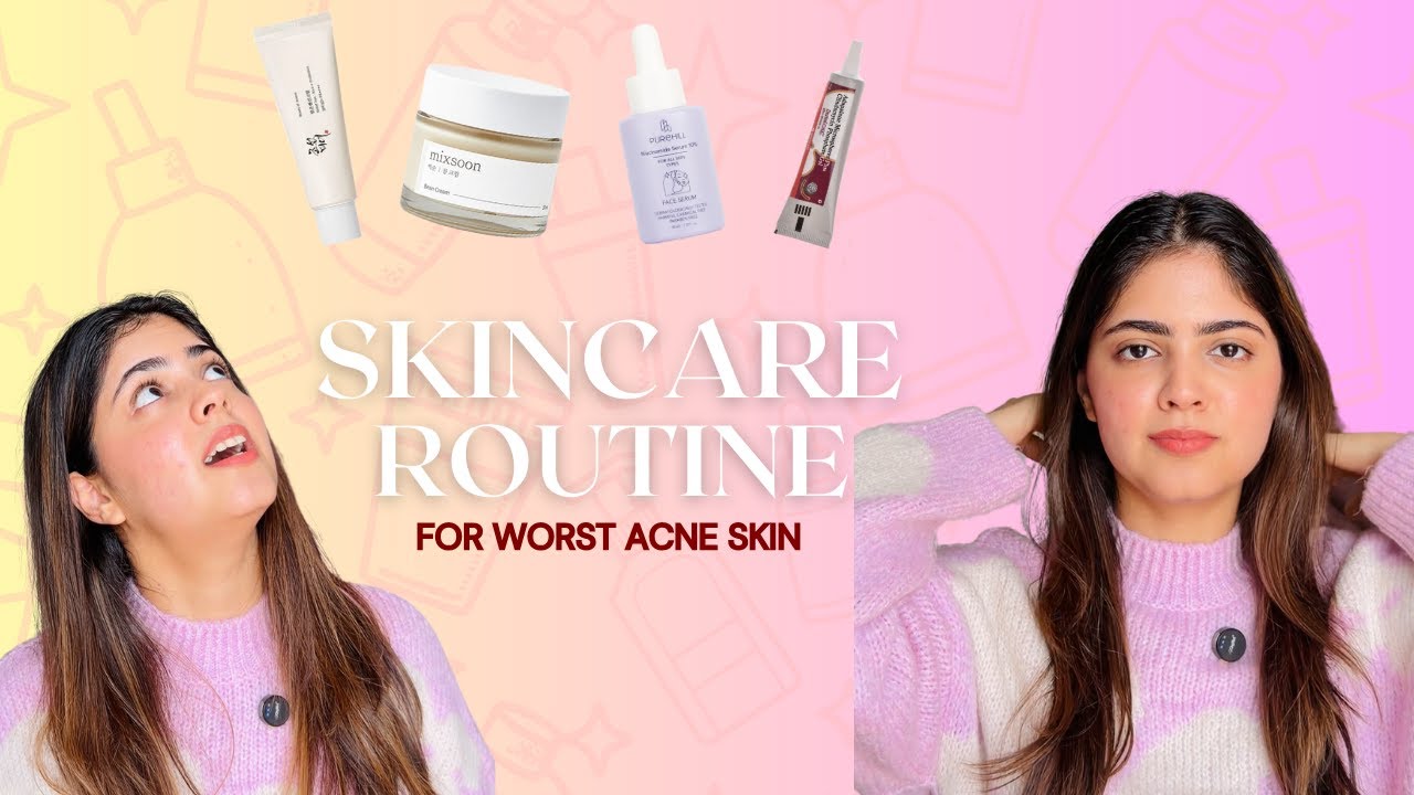 I Tried Everything for Acne & This Is What Helped | Skin Care Routine, Products, Tips, Mistakes