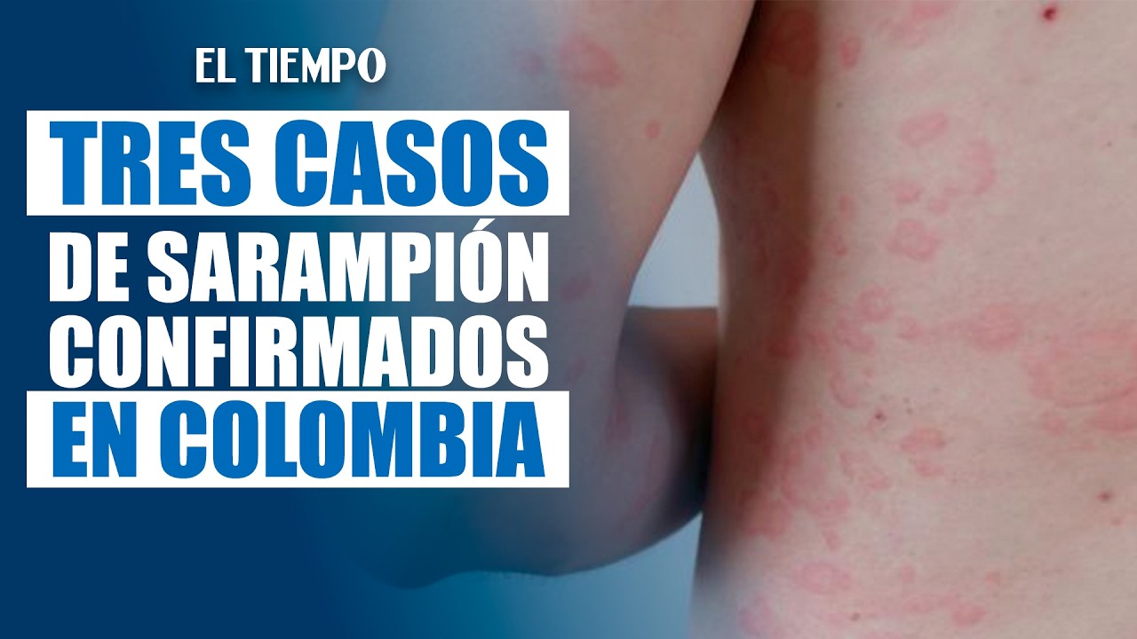 Alerta por sarampión en Colombia: confirman tres casos importados | EL TIEMPO