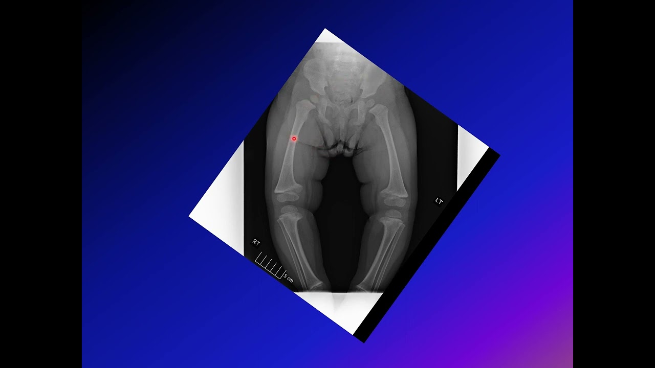 Blount's Disease (Tibia vara)