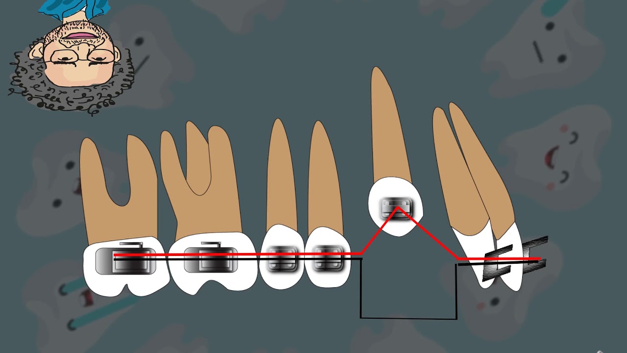 Mechanics of Buccal Canine alignment (piggyback)