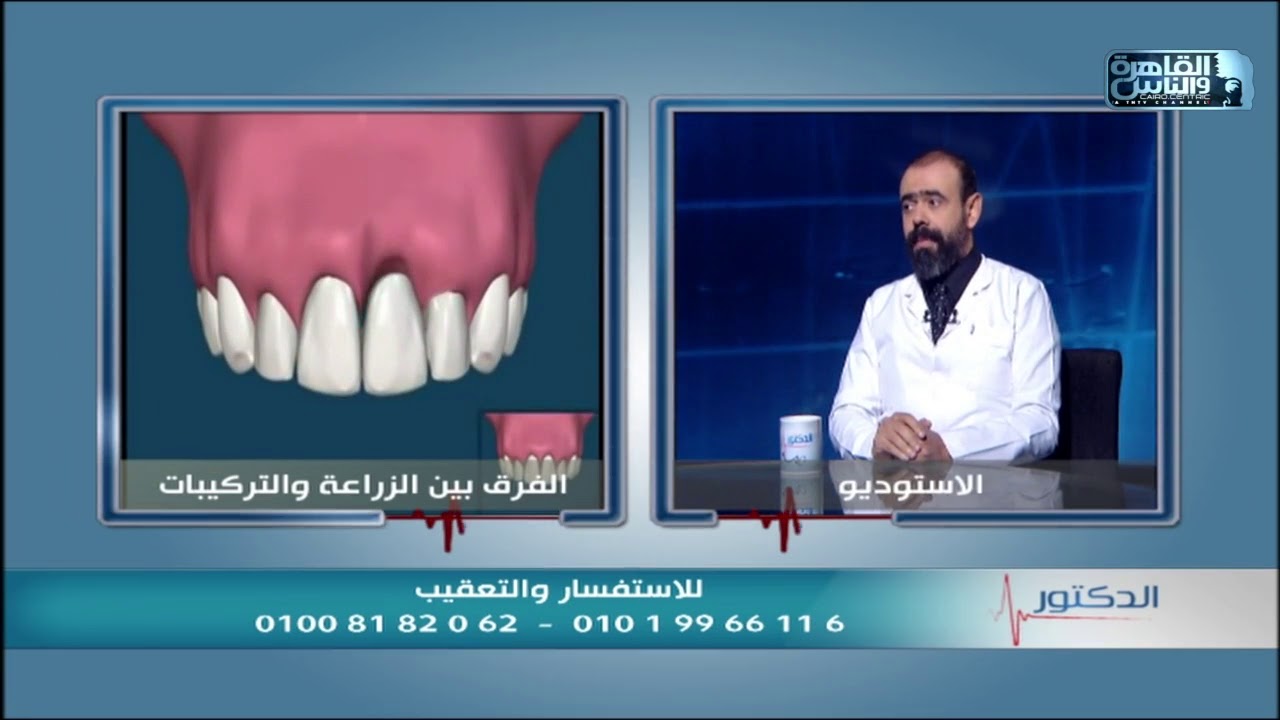 أعرف عمل الزراعة أفضل أم عمل تركيبة ثابتة بدلا من الأسنان المفقودة