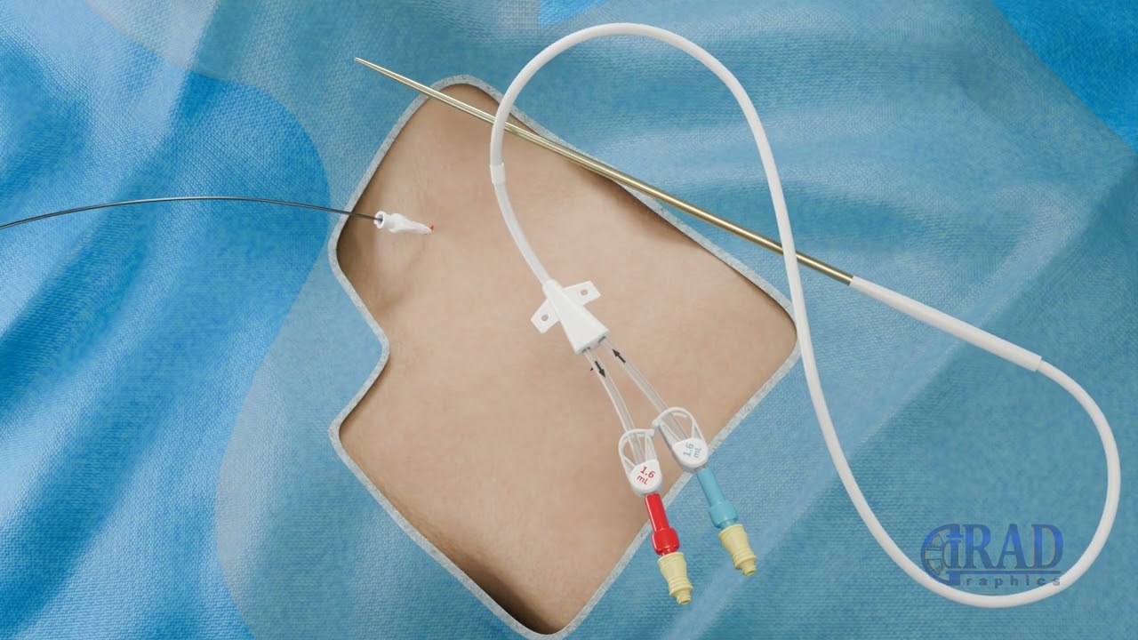 Tunneled Dialysis Catheter Placement
